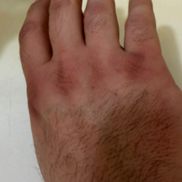 L’équipe de campagne de Thibaut Guiraud dénonce les brûlures subies par ses colleurs. | Photo transmise par le candidat