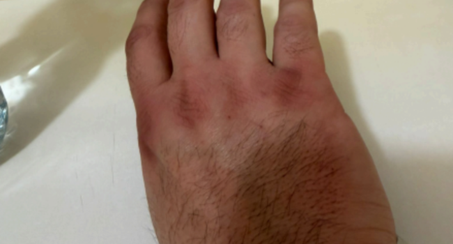 L’équipe de campagne de Thibaut Guiraud dénonce les brûlures subies par ses colleurs. | Photo transmise par le candidat