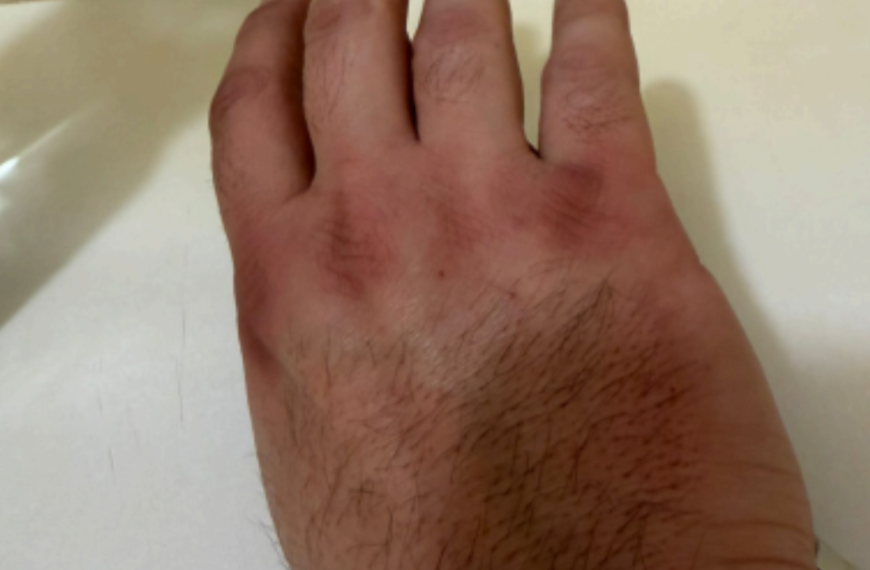 L’équipe de campagne de Thibaut Guiraud dénonce les brûlures subies par ses colleurs. | Photo transmise par le candidat