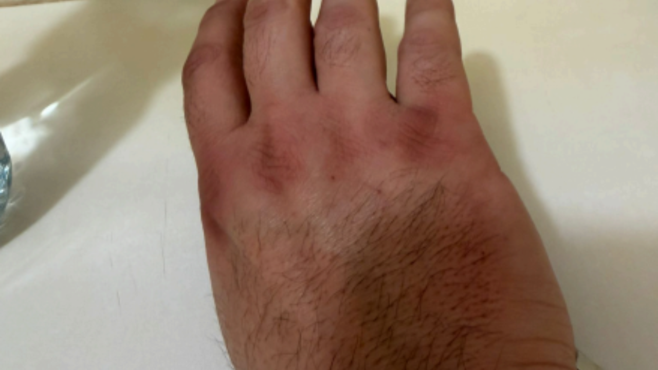 L’équipe de campagne de Thibaut Guiraud dénonce les brûlures subies par ses colleurs. | Photo transmise par le candidat